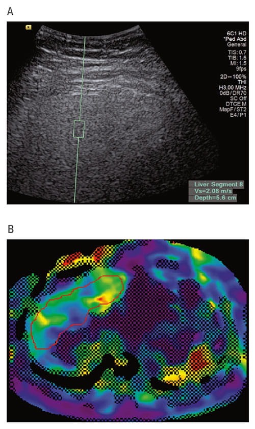 Fig A+B:  These ultrasound (A) and MR elastography (B) images of the liver are from a study patient with a BMI of 35.7 kg/m2. The green box in the ultrasound image is where the liver stiffness measurement is being made. The color coding in the MRI image reflects areas of the liver that have different measured stiffness values. 